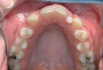 d. Proclination of teeth: Removable or fixed appliance.