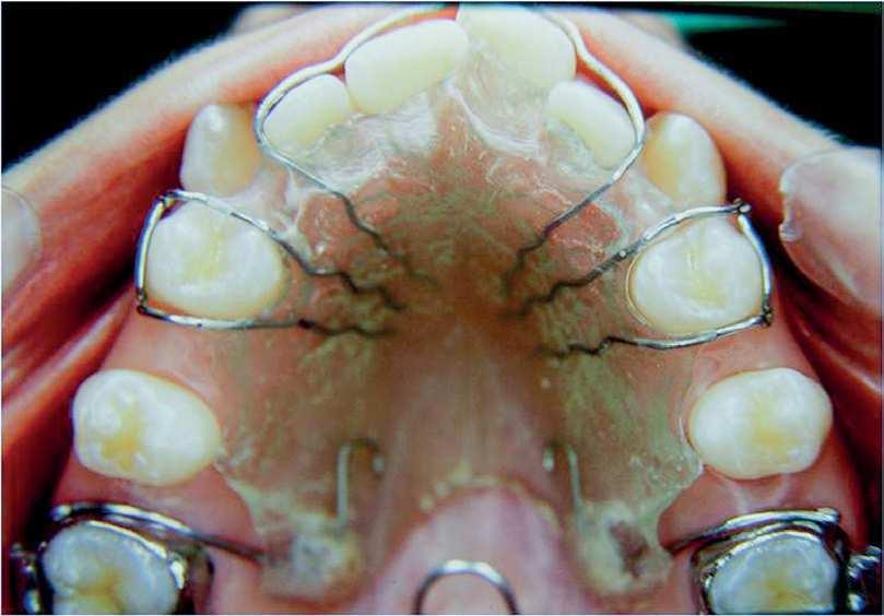 2 The maxillary ixed orthodontic appliance (Roth prescription) was placed only ater molar occlusion was over corrected (Fig 10).