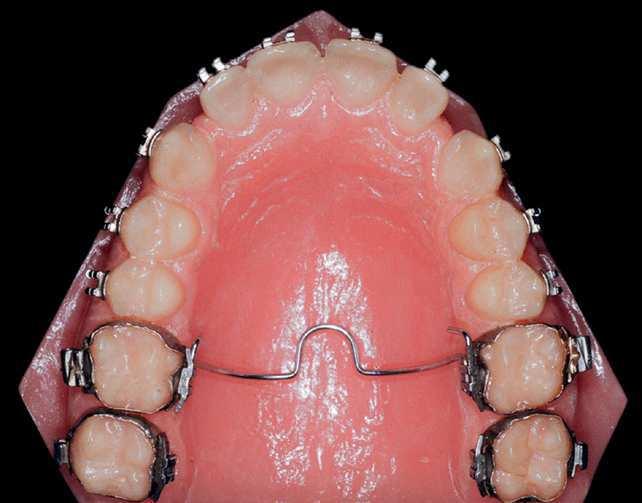 rotation of mandibular molars following the movement of maxillary molars (Fig 12).