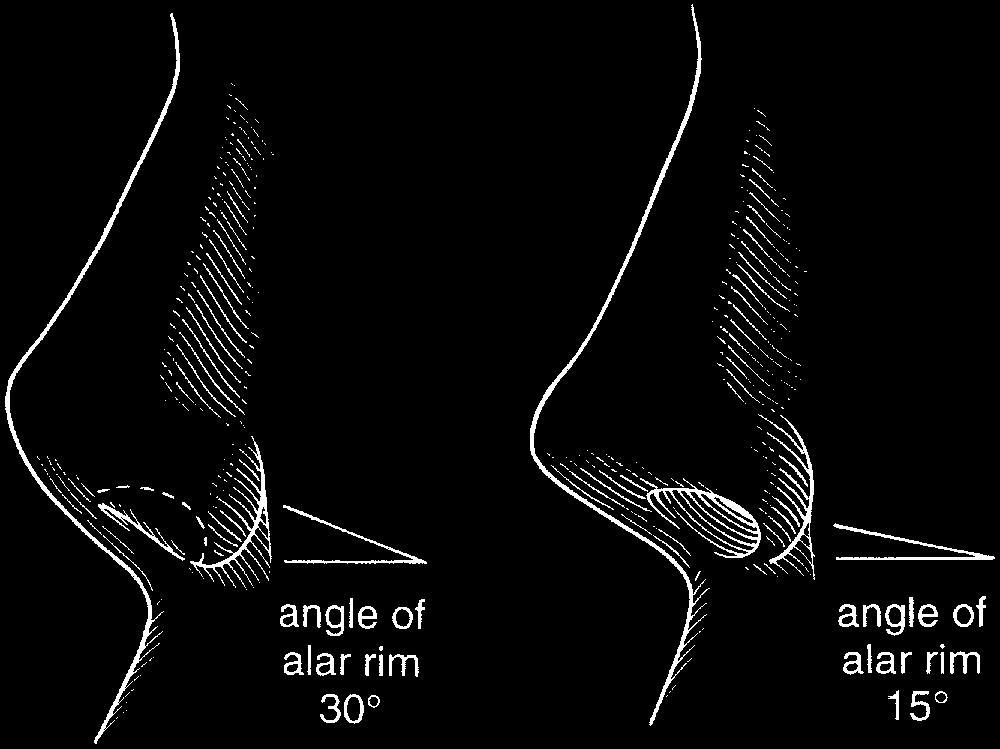 Figure 19. Correction of the foreshortened nose. y changing the angle of both the columella and the ala rim, the nose appears less upturned. Figure 20.