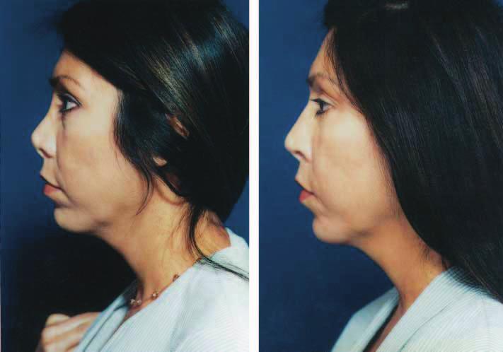, Postoperative view 6 months after lengthening of foreshortened nose demonstrates correction using described technique. formation, dehiscence, inadequate excision, and asymmetry, has been low.