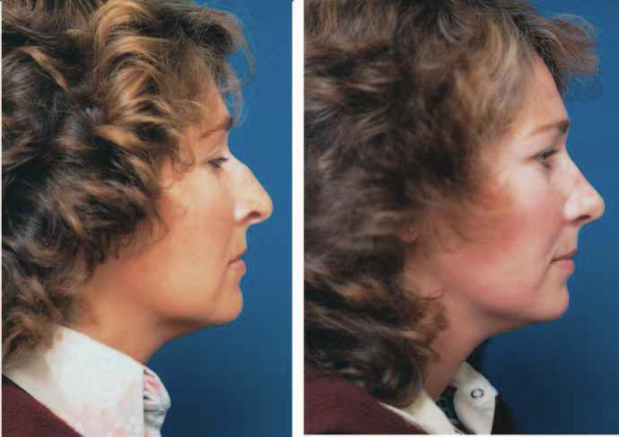 The columella (medial crus cartilage) was elevated slightly. Figure 3., Preoperative view of a 36-year-old woman with high-arched nostrils.
