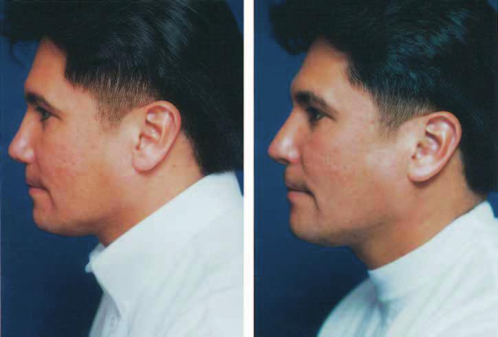 , 41-year-old man with a hidden columella after 3 rhinoplasty procedures.
