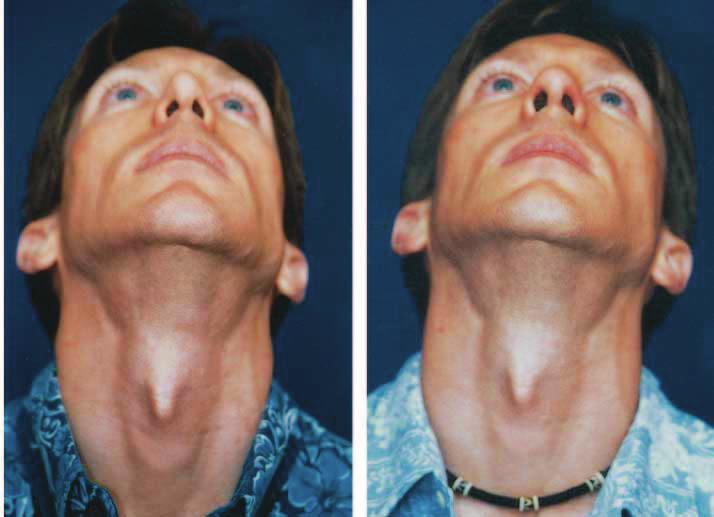 This technique can be used for traumatic, congenital, or cleft lip asymmetry. can be extended by excising tissue in the soft triangle area to create a better tip-to-nostril proportion.