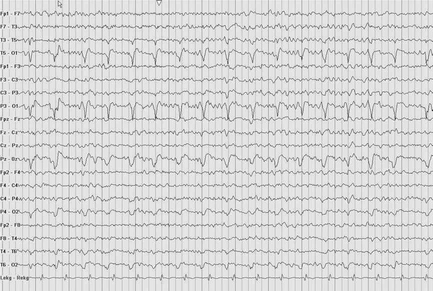 247 Figure 8.8: PLEDs. The EEG shows an unusual case of occipital PLEDs in a 32-year-old man with an occipital infarction.