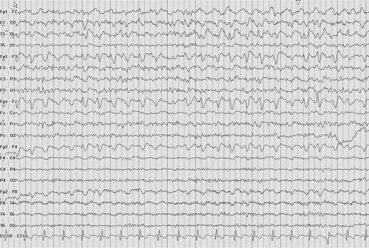 250 A Figure 8.11: EEG in brain abscess.