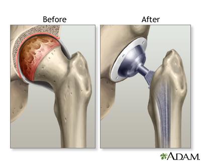 Background - Hip/Knee Arthroplasty - Joint Replacement/Reconstruction - 2 Types -