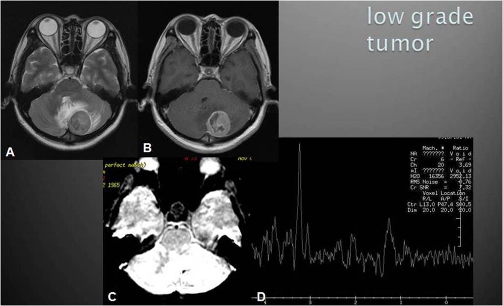 Fig. 7: A 44-year-old female with low grade tumor (meningioma, WHO grade I) was misdiagnosed as high grade tumor due to nonspecific MRS pattern.