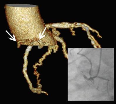 Coronary computed tomography Information on the occluded segment: course length tortuosity calcification resolve issues of anatomic ambiguity Identification of