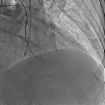 Single-wire antegrade CTO techniques: sliding support by a micro-catheter gently advancement and rotation to find micro-channels check for the wire