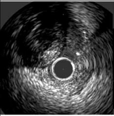 Re-entry strategies: IVUS guided technique