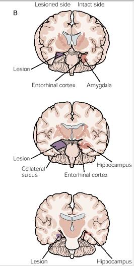 medial temporal lobe lesion for status epilepticus in 1953 The medial