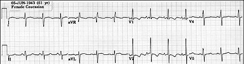 Eisenmenger s Syndrome R to L flow via VSD Pressure: Pulmonary = Aortic Resistance Pulmonary > Aorta RV