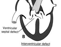 Defect (ASD) Left atrium to Right atrium VSD most common CHD (20%) 2/1000 live births Can occur anywhere in the IVS Location of VSD has no effect on shunt Perimembraneous most common (75%) Muscular