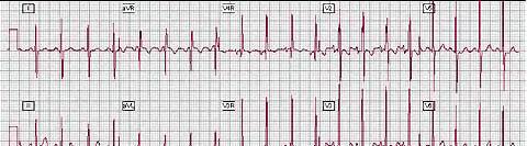 VSD: Electrocardiogram VSD: