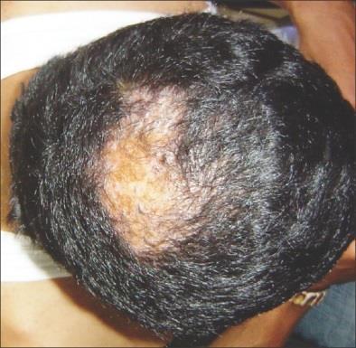 Scalp (lichen planpilaris) - It is rare, but this disease can develp n the scalp.