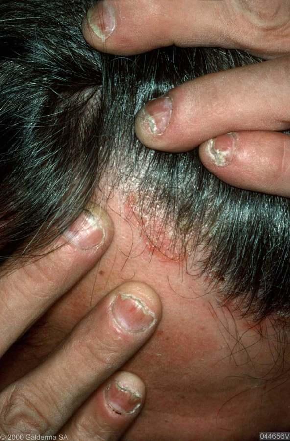 Patient no 2 Age 25 years Has had problems with her scalp for many months Severe dandruff, no benefit from