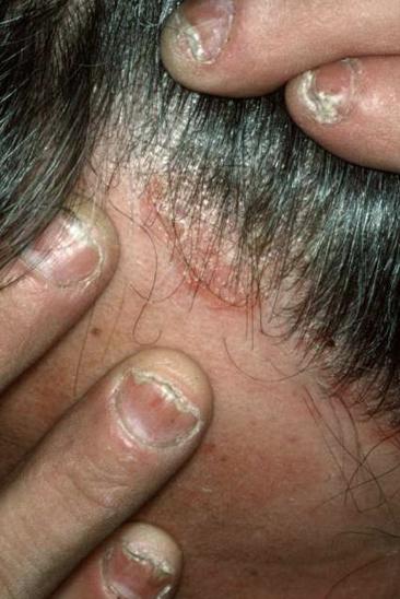 Scalp psoriasis History of patient, including treatments tried and