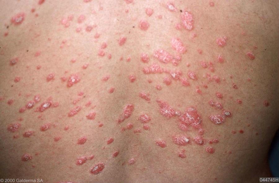 Patient no 3 18-year-old girl with sudden onset widespread small scaly lesions No previous