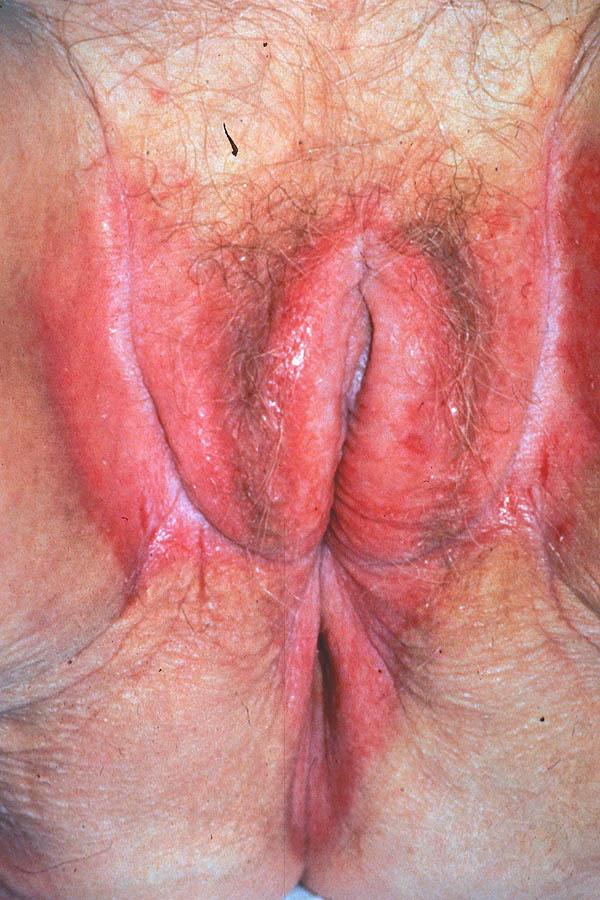 Patient no 4 A 59-year-old lady attending for smear