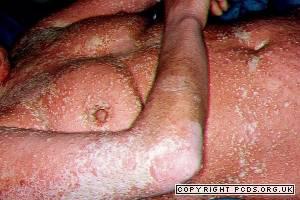 Severe pustular psoriasis Copied