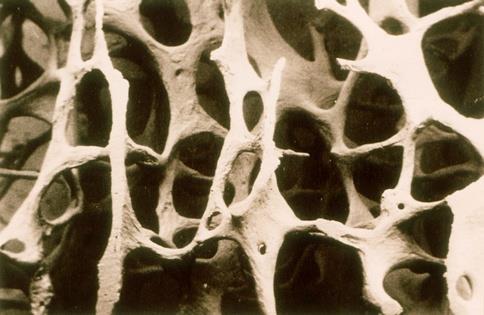 calcitonin, denosumab or SERM) Severe Osteoporosis Bone