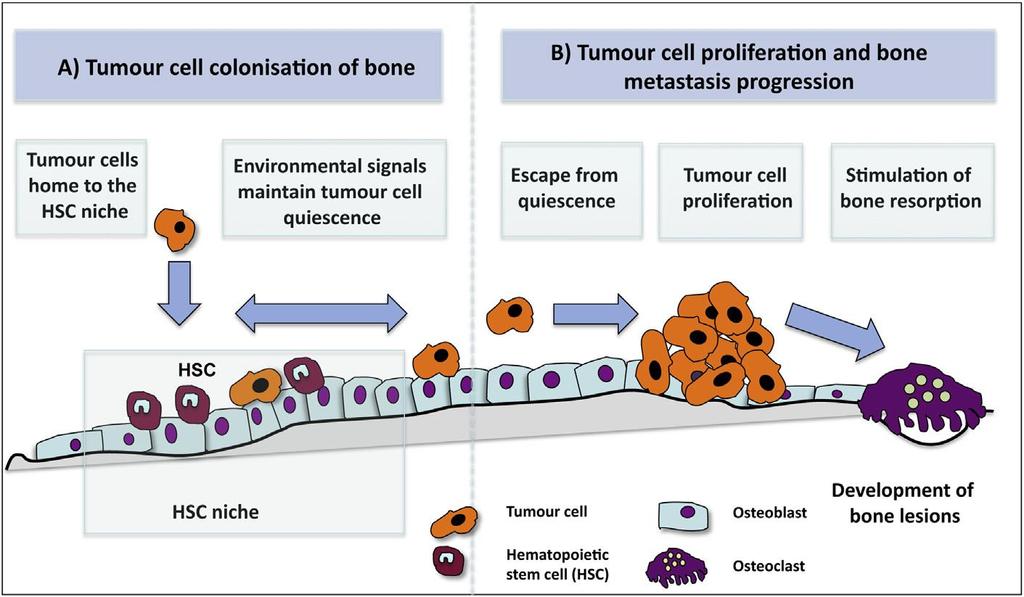Stages of BC bone metastases R.E.