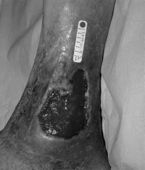 ulcers Hyperpigmantation Symptoms of Venous Insufficiency Heaviness Swelling Pain with prolonged