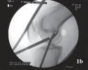 The knee was flexed to more than 90 and the femoral tunnel was drilled through the transtibial approach.