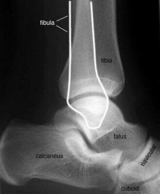 Lateral View of the Ankle Posterior tibial tuberosity fractures & direction of fibular injuries can be identified Any deformity to the talus, calcaneus or