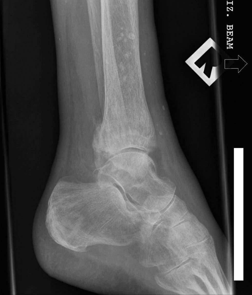 Bimalleolar fractures Osteopenic appearing