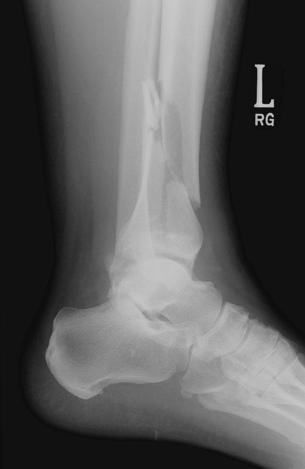 Mortise view Pilon fracture (Comminuted tibial plafond