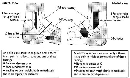 Indications for Ankle Radiographs