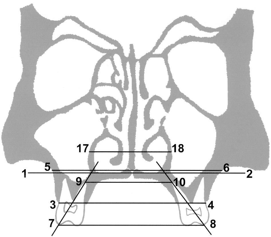 The CTs were obtained using a standardized frontal plane orientation, i.e. with the subject positioned facedown with the neck hyper-extended and the scanning plane at 90 degrees to the plane of the hard palate.
