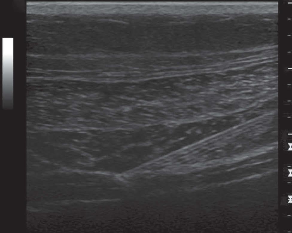 involvement resulting from ultrasound-guided TAP block.
