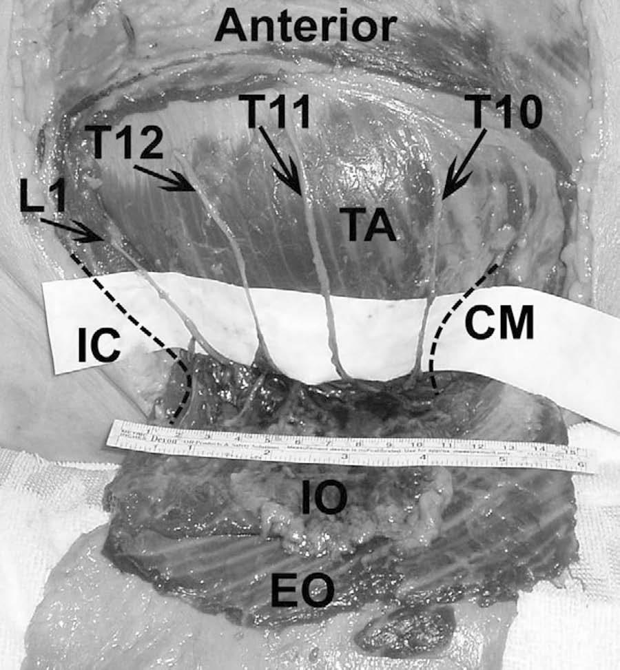 Ultrasound-guided transversus abdominis plane block After the dye injection, its extent of spread within the TAP was determined by dissection of the hemi-abdominal wall.