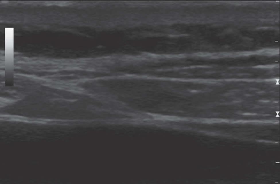 Ultrasound-guided transversus abdominis plane block GE Le RA SC EO IO TA 1 nerves mostly lie in the TAP is the basis of the TAP block regardless of the exact technique and our dissections confirm the