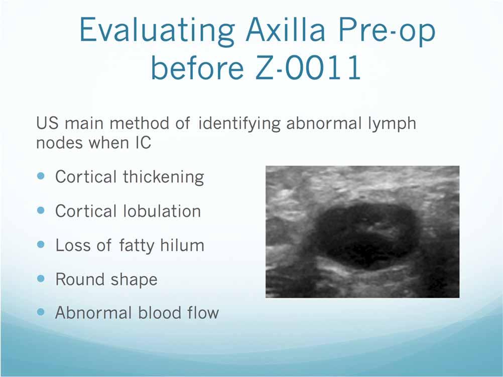 Evaluating Axilla Pre-op before Z-0011 US main method of identifying abnormal lymph nodes when IC Cortical thickening Cortical lobulation Loss of fatty hilum Round
