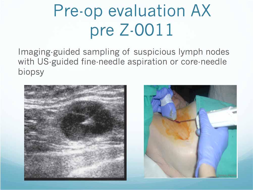Pre-op evaluation AX pre Z-0011 Imaging-guided sampling of suspicious