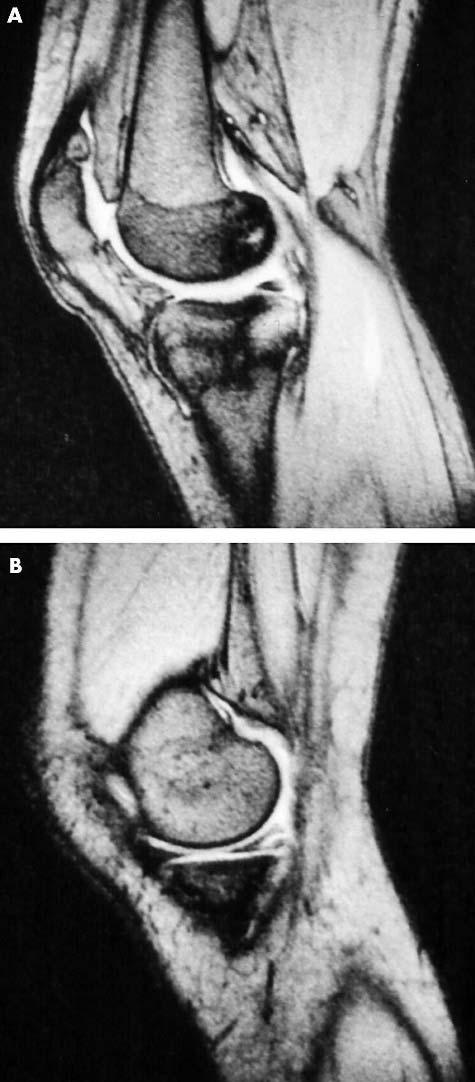 Kissing contusion in the acutely injured knee 593 is located primarily within the medullary cavity of the bone, without cortical interruption.