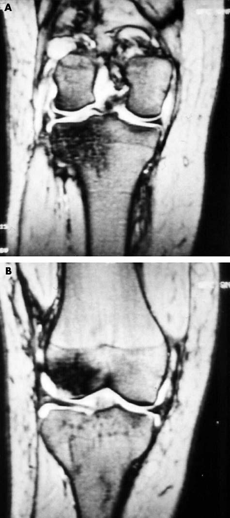 In four of the cases (table 2, cases 4, 5, 12, and 13), the bone contusion was located on the terminal sulcus on the lateral femoral condyle (type I and type II) and on the posterolateral tibial