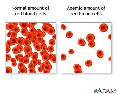 Anemia is a condition caused by an inability of the blood to carry sufficient oxygen to the