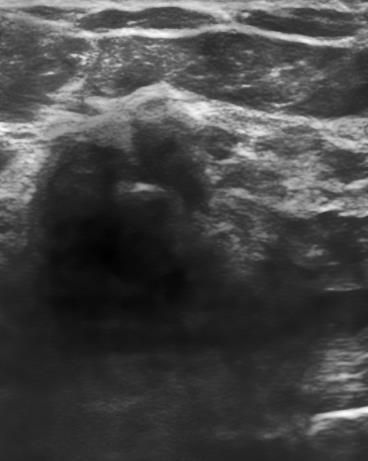 Initial Results: Clinical Data Original Ultrasound (Siemens Acuson S2000) ClearView Post-Processed Palpable 2 cm ill-defined mass on right breast BI-RADS : 5 Highly suggestive of malignancy