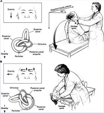 BPPV Diagnostic criteria Posterior canal BPPV Upbeating torsional nystagmus Repeated episodes of vertigo with changes in head position Vertigo associated with nystagmus provoked by Dix Hallpike