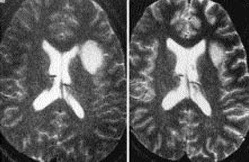 L. D. Lunsford, et al. FIG. 3. Magnetic resonance T 2 -weighted images in a 22-yearold student who had headaches and partial complex seizures. Left: Left deep frontal mass revealing an astrocytoma.