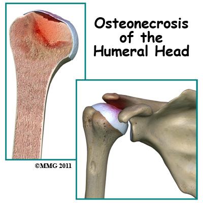 Introduction Osteonecrosis of the humeral head is a condition where a portion of the bone of the humeral head (the top of the humerus or upper arm bone) loses its blood supply, dies and collapses.