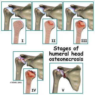 Symptoms What does osteonecrosis feel like? The first symptom of osteonecrosis of the humeral head is shoulder and arm pain. The location of the pain is difficult to isolate.