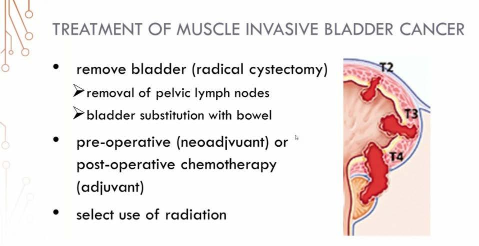 Highlighting Clinical Trials Muscle Invasive Bladder Cancer Part I: The Basics of MIBC Clinical Trials June 19, 2018 Presented by: Dr.