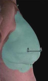 Tissue expanders work to stretch the overlying skin after mastectomy, creating an enlarged, projected pocket for placement of a permanent implant.