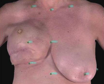 Mioton LM et al. Breast projection after prosthetic reconstruction loss ± standard deviation, 21.04% ± 12.43%) (Fig. 3). Fig. 4 illustrates the mean loss in projection over time.